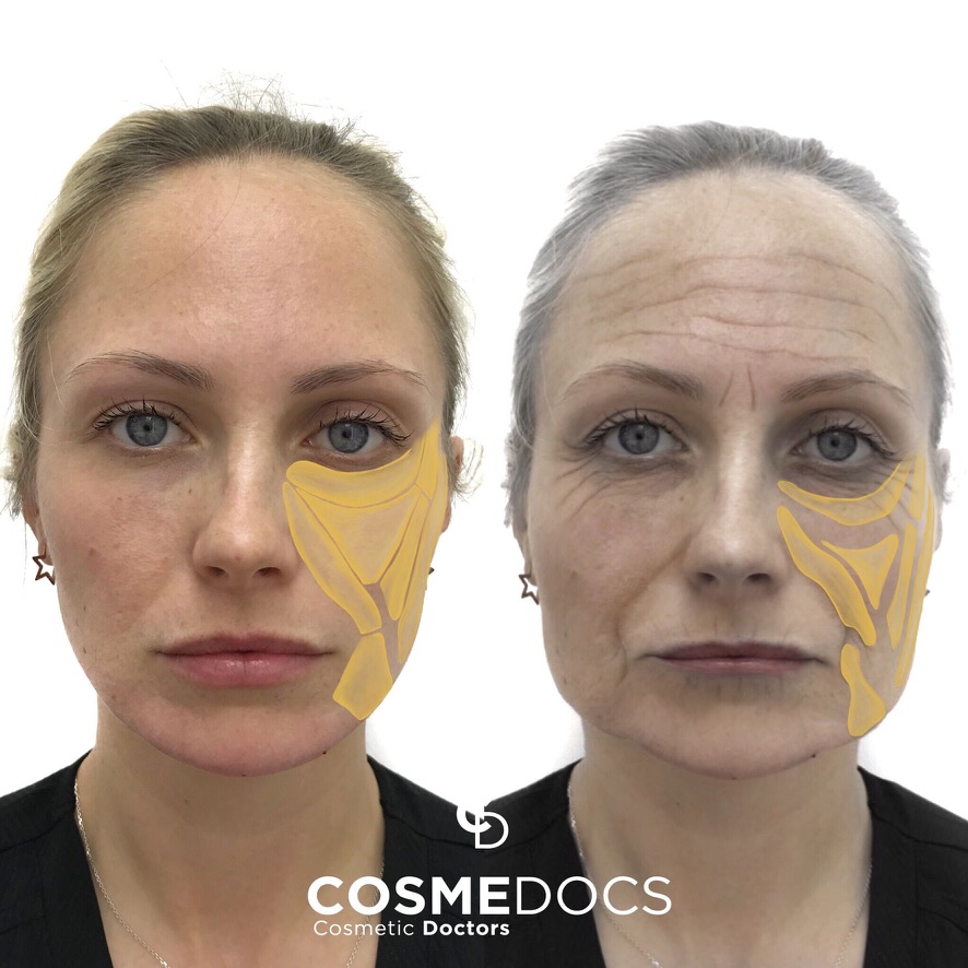 Facial fat compartments illustrated on a young face and an older face — showing how youthful continuity fragments into visible units with age