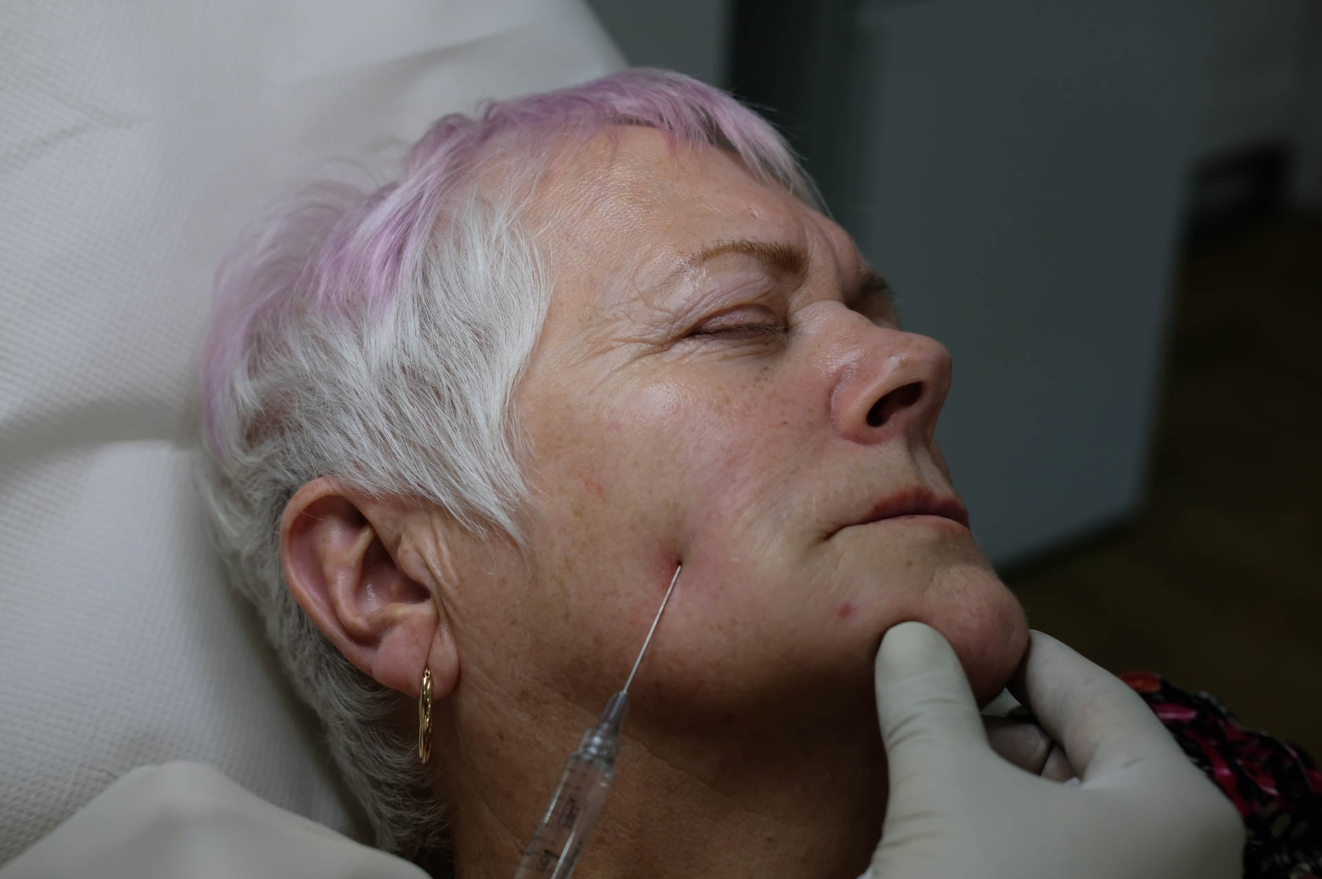 Cannula in the superficial subcutaneous layer at a consistent shallow depth