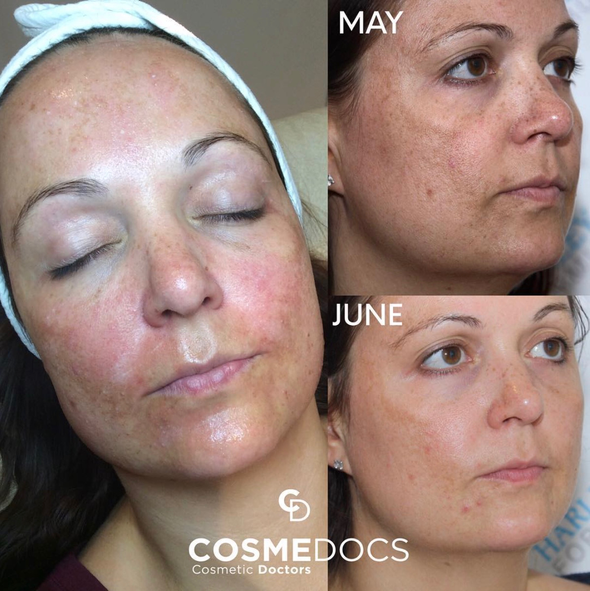 Clinical presentation of bilateral facial pigmentation similar to melasma