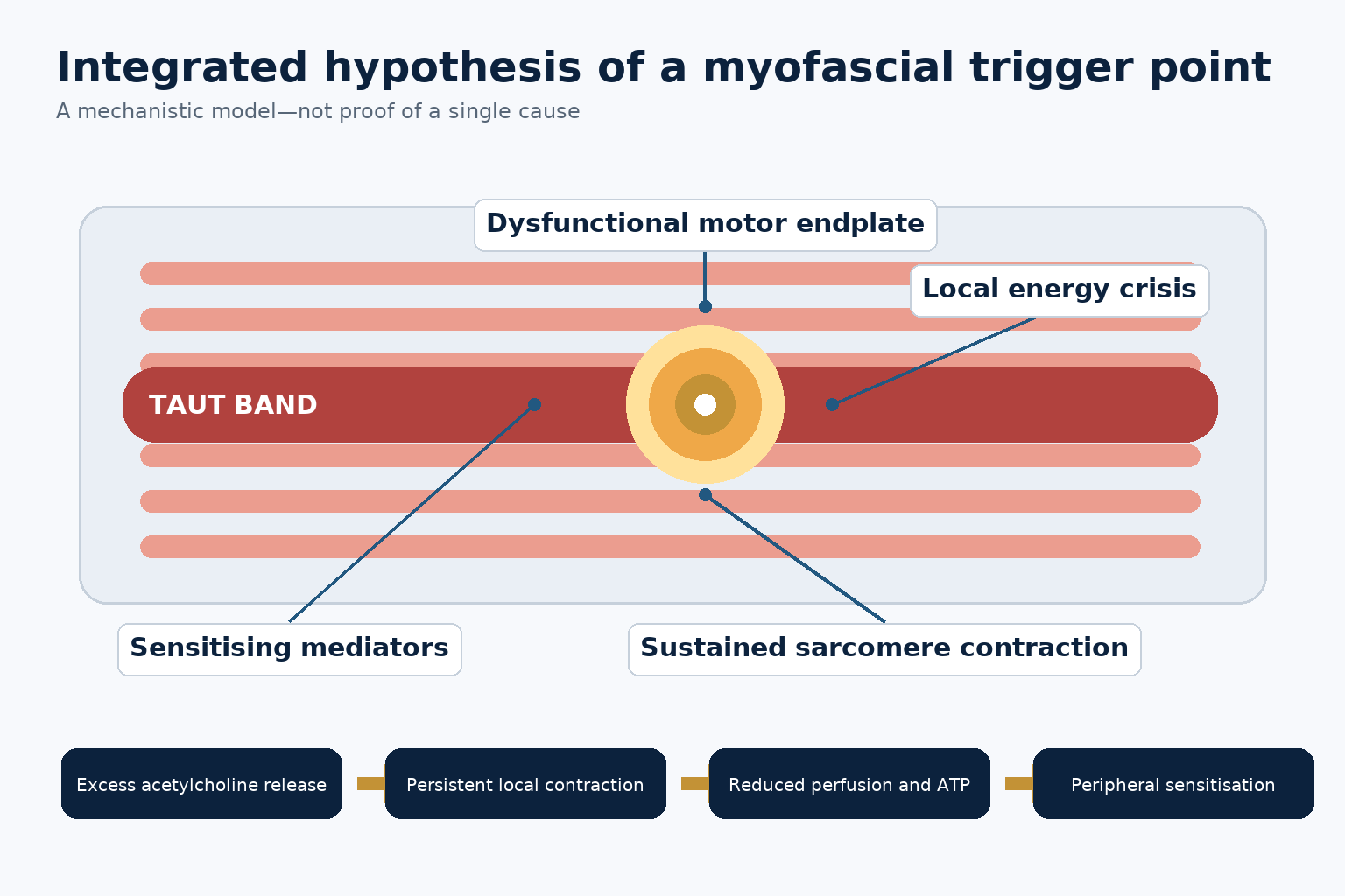 Diagram of the integrated hypothesis of a myofascial trigger point, showing a taut band, dysfunctional motor endplate, local energy crisis, sustained sarcomere contraction and sensitising mediators