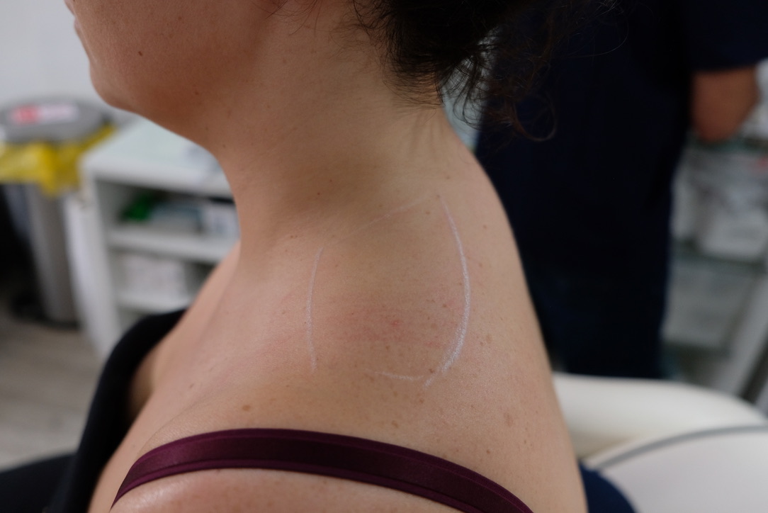 Trapezius Botox injection points marked in white on a patient’s shoulder and neck before treatment