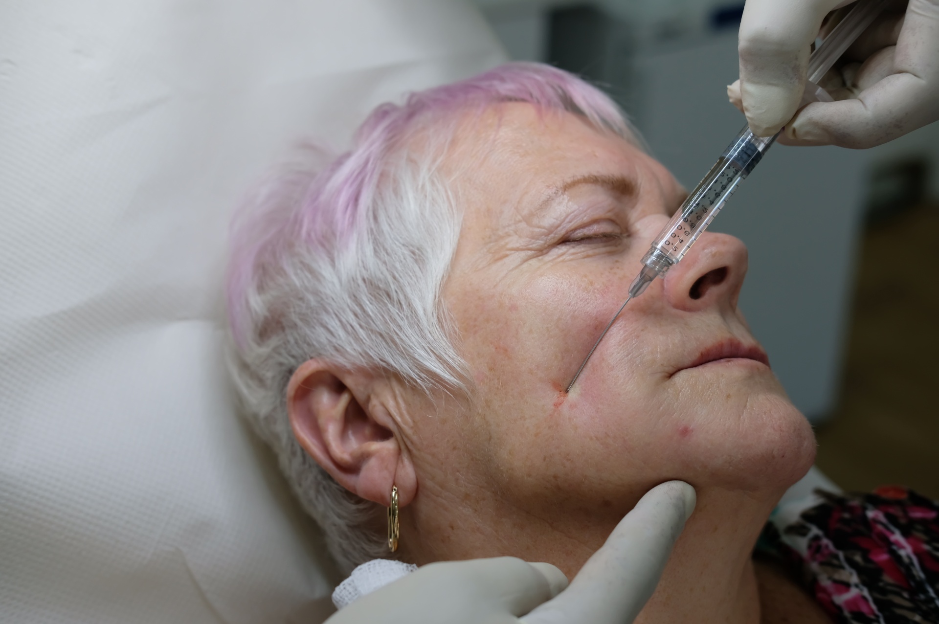 Cannula in the superficial subcutaneous layer at a consistent shallow depth