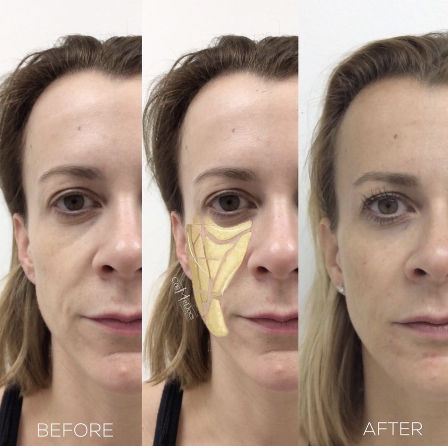 Before and after facial filler treatment showing restoration of subcutaneous volume across the cheek, tear trough, nasolabial area and pre-auricular region