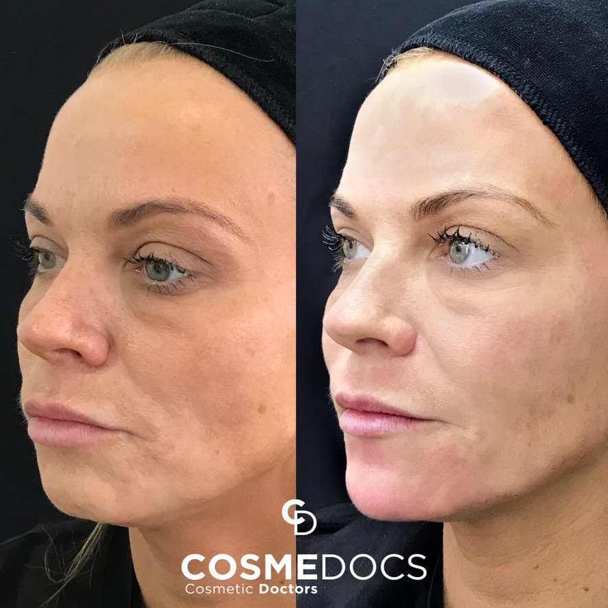 Before and after aesthetic treatment showcasing facial volumisation and contouring by Dubai masterclass graduate