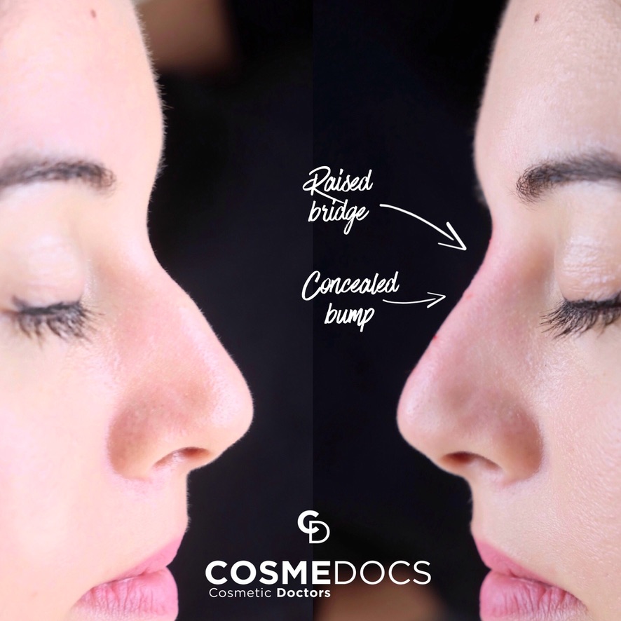 Before and after nasal bridge filler showing non-surgical nose reshaping by Dubai Harley Street trained practitioner