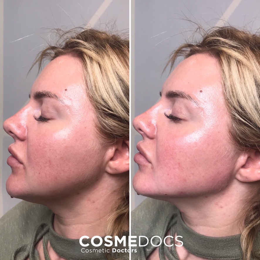 Before and after facial filler treatment showing cheek and jawline definition by Dubai masterclass alumnus