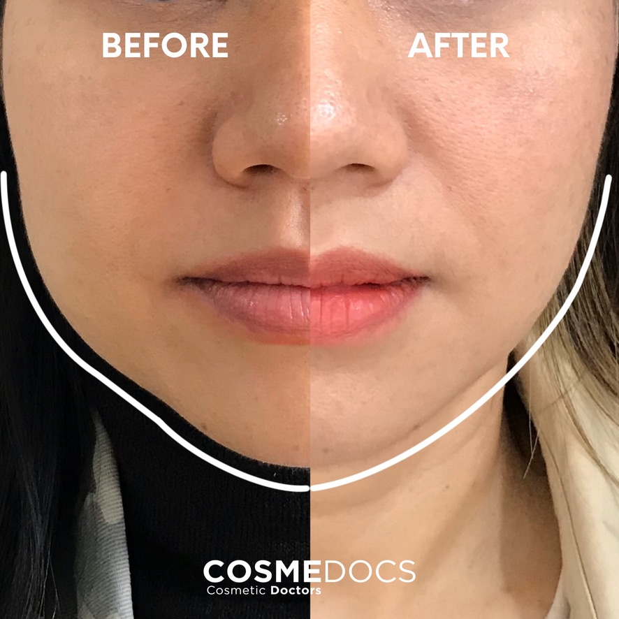 Before and after lower face treatment showing improved facial harmony and proportion