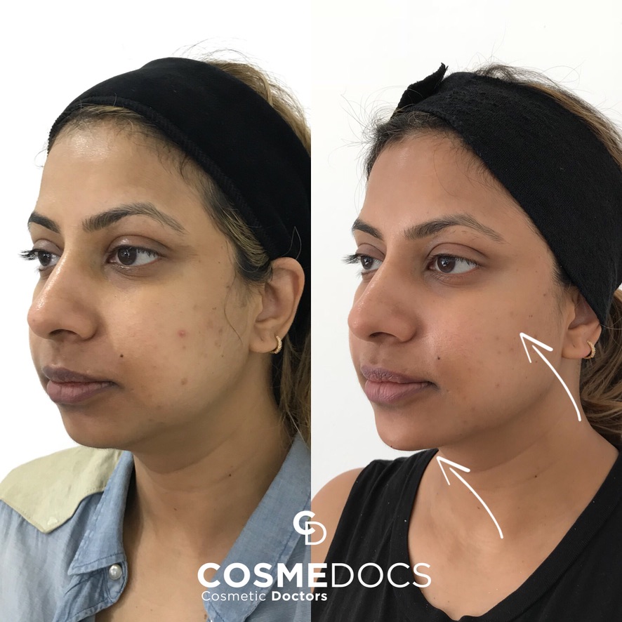 Before and after dermal filler treatment showing enhanced jawline definition and facial contouring