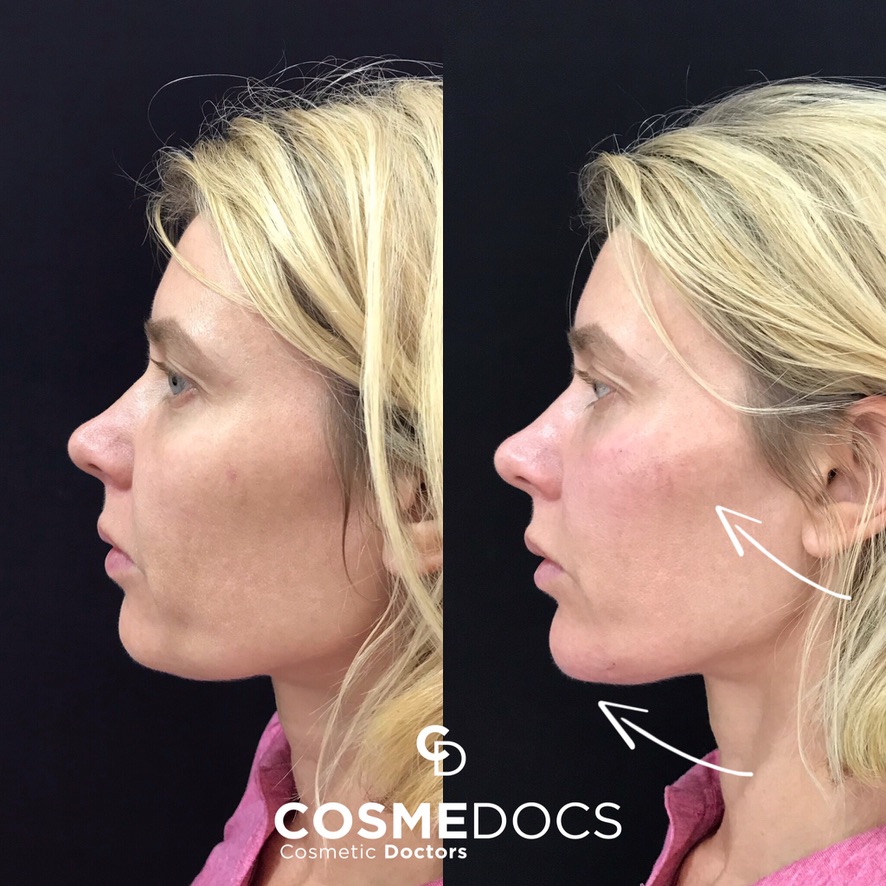 Jawline and profile enhancement treatment results