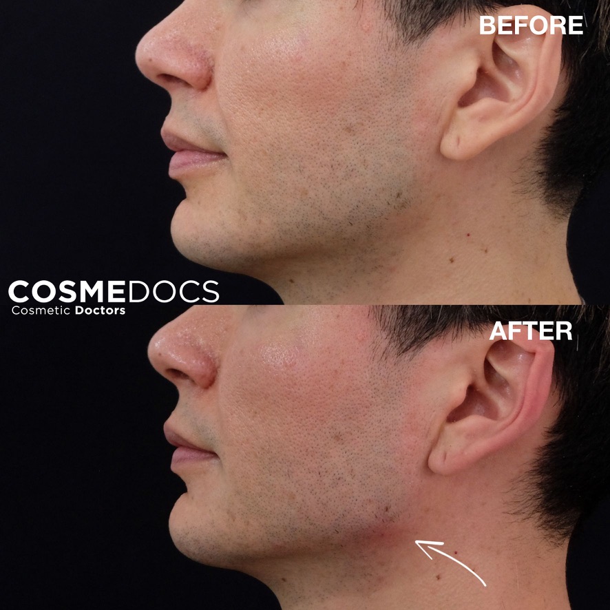Before and after male jawline treatment showing defined masculine features