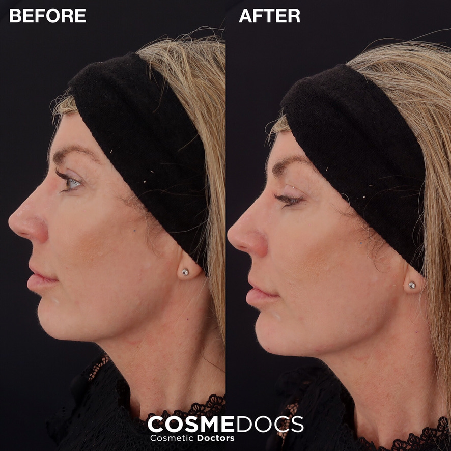 Facial contouring treatment before and after