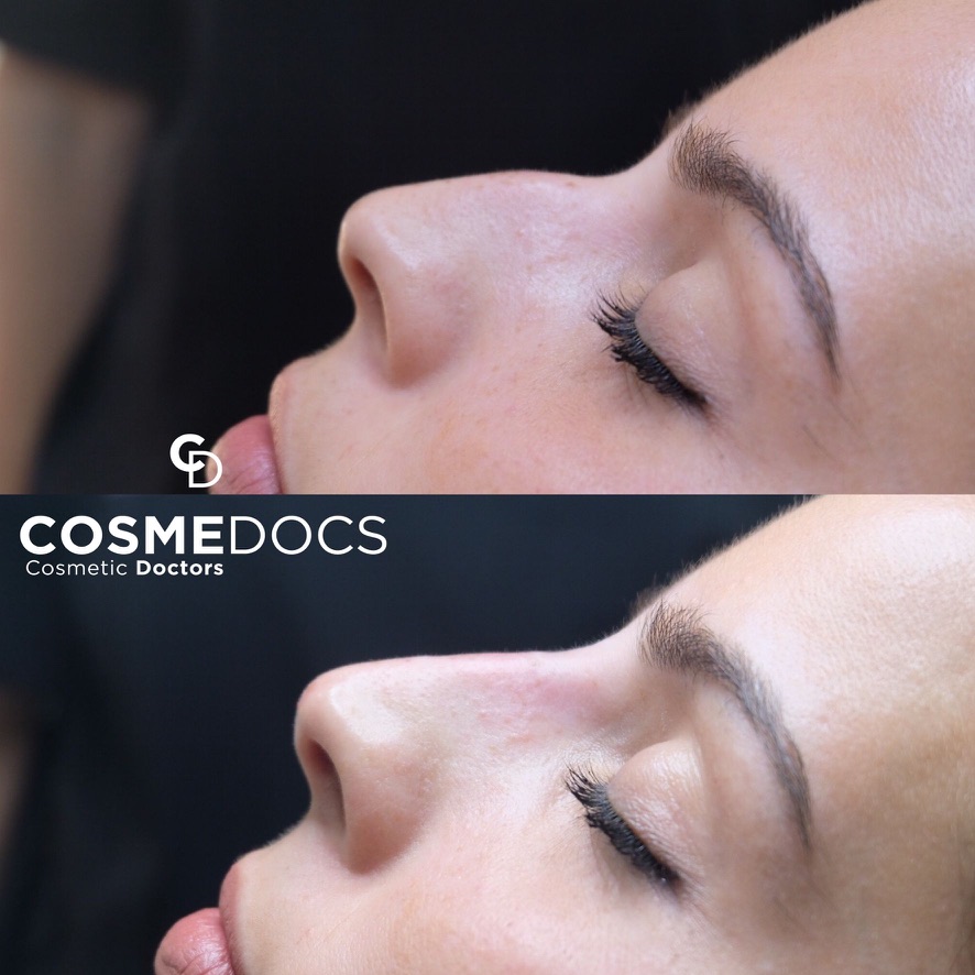 Before and after nose reshaping non-surgical rhinoplasty treatment