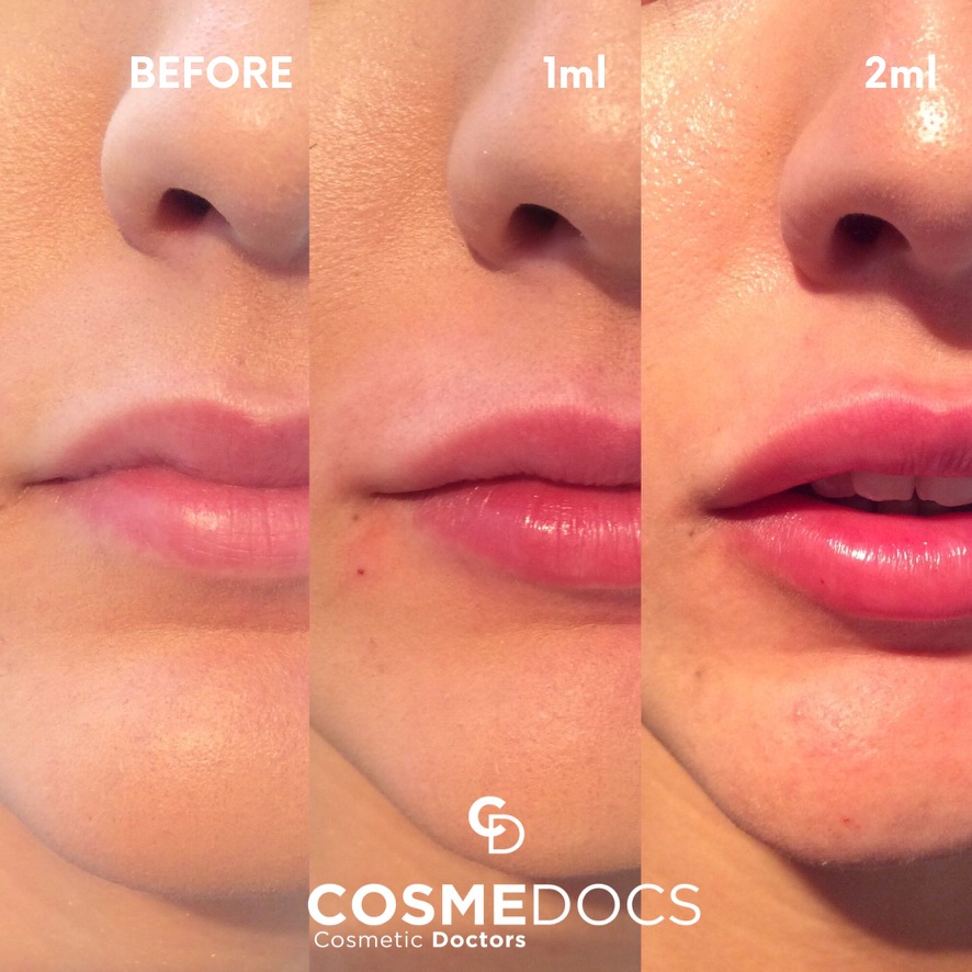 Before and after lip filler treatment progression showing 1ml and 2ml results