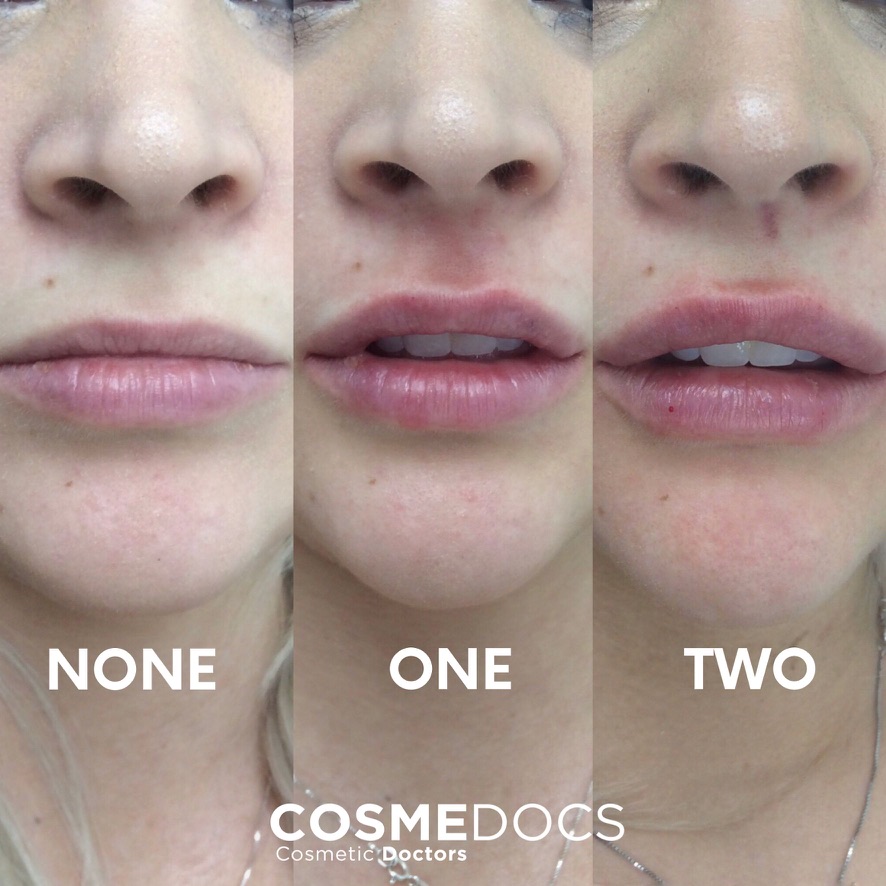 Before and after lip treatment showing gradual enhancement over multiple sessions