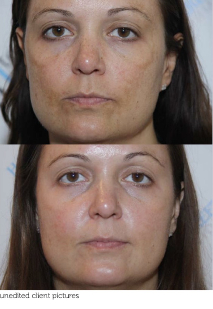 Client with melasma before and after treatment showing improved skin tone and reduced pigmentation with vitamin C retinol and fusion peels