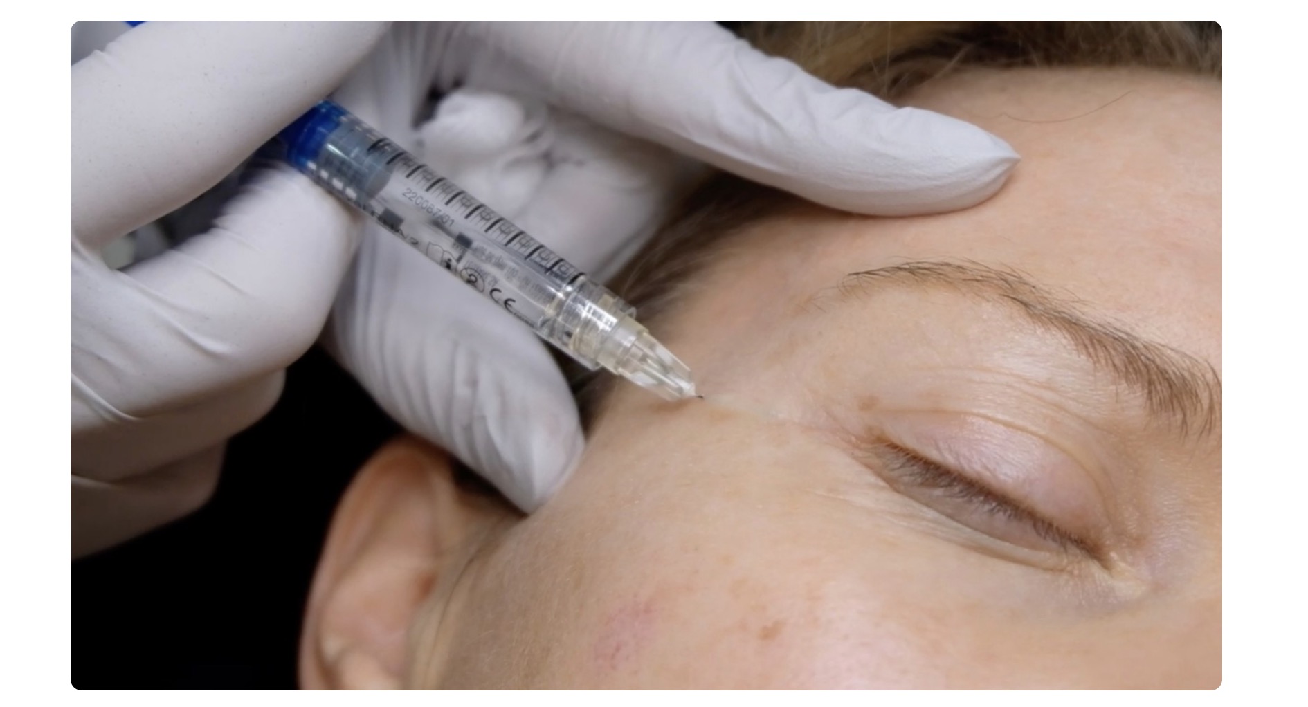 Dr Ahmed Haq demonstrating dermal filler injection depth - identifying dermal layers during aesthetic treatment