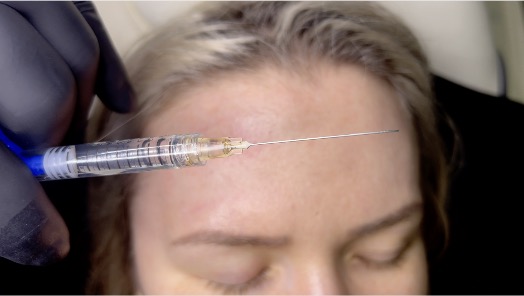 Forehead Indentations Treatment With Dermal Fillers - Advanced Training