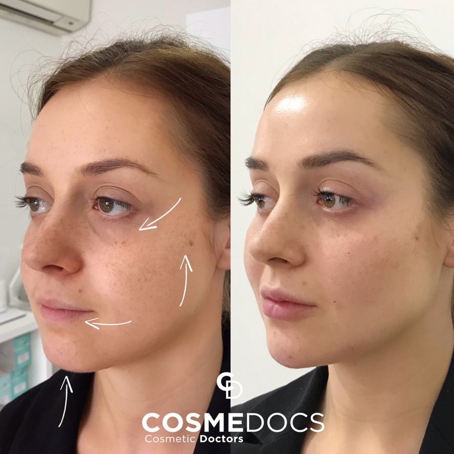 Before and after photos showing gentle makeover results with dermal fillers for facial enhancement