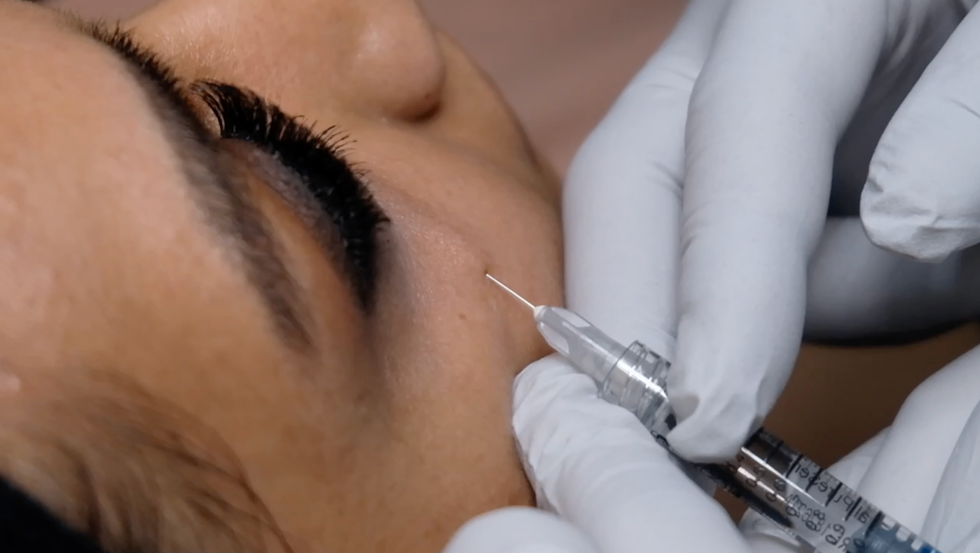Expert aesthetic injection technique near eye area demonstrating precision training methodology for Middle Eastern practitioners