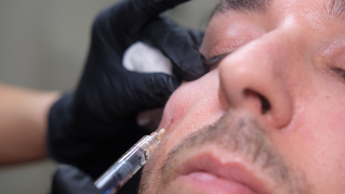 Advanced facial injection technique near nose demonstrating anatomical plane mastery for diverse Middle Eastern skin tones