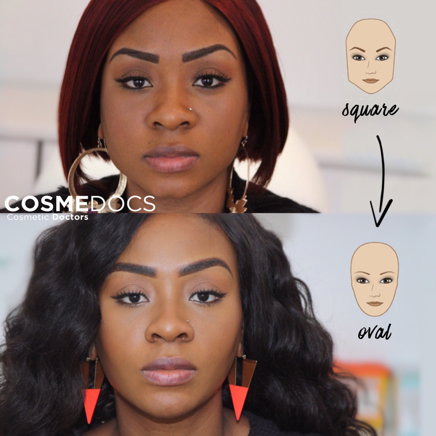 Before and after comparison showing jaw reduction results for bruxism treatment and achieving a slimmer, more contoured facial appearance