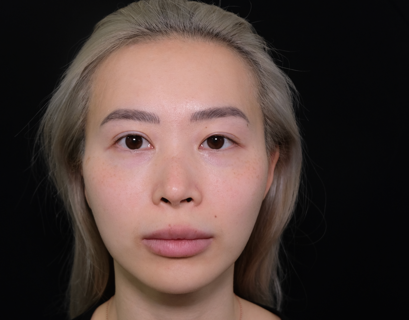 Patient frontal view after masseter botox treatment showing reduced jaw width and improved facial contour