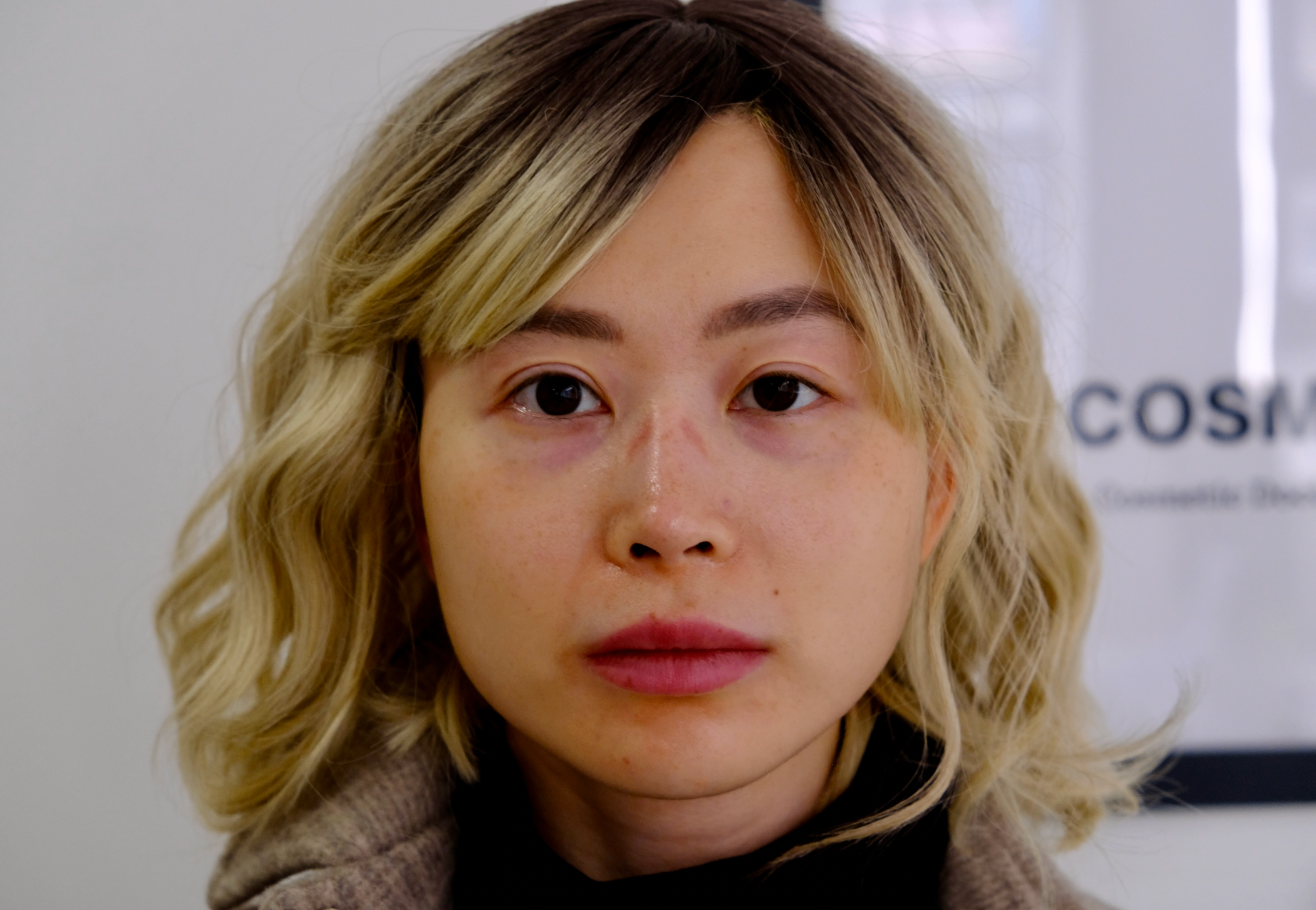 Patient frontal view before masseter botox treatment showing masseter hypertrophy