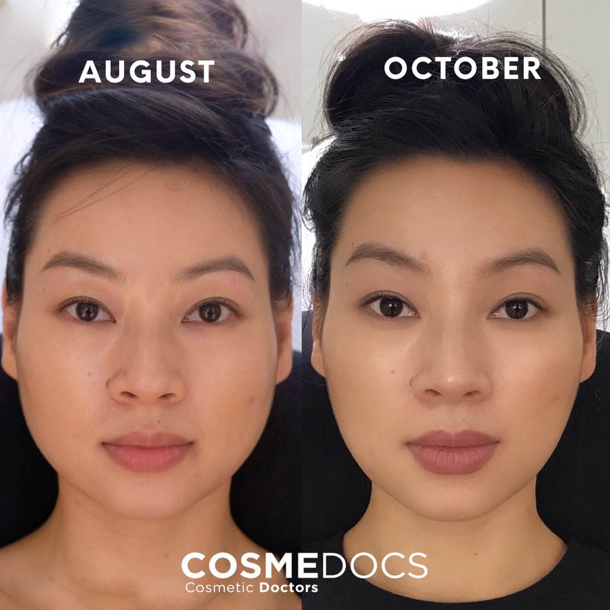 Masseter Botox before and after results showing jawline slimming - demonstrates reduction in masseter muscle hypertrophy and facial contouring achieved through botulinum toxin treatment