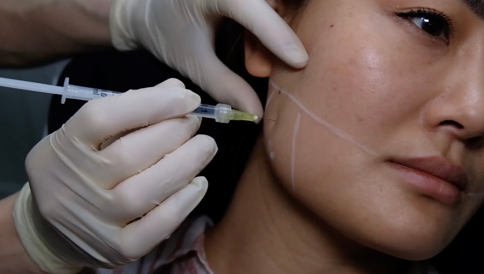 Masseter Botox Course For Wide Jaw, Bruxism/TMJ - Online Course