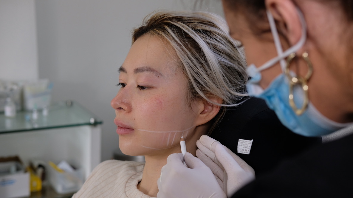 Practitioner marking jawline injection points for masseter botox treatment planning