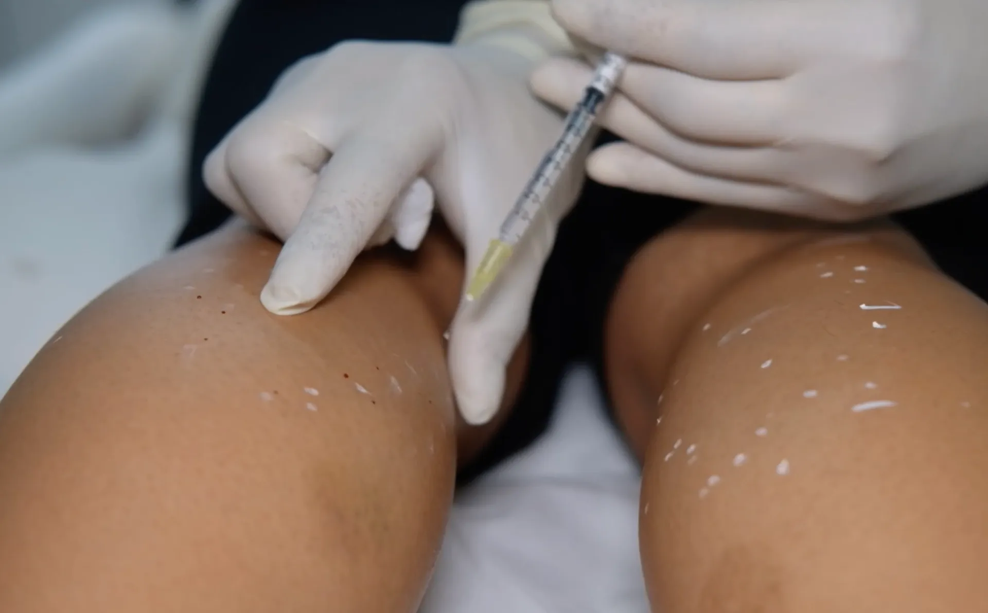 Botulinum Toxin for Calf Compartment Syndrome: A Novel Approach - Research in aesthetic medicine training