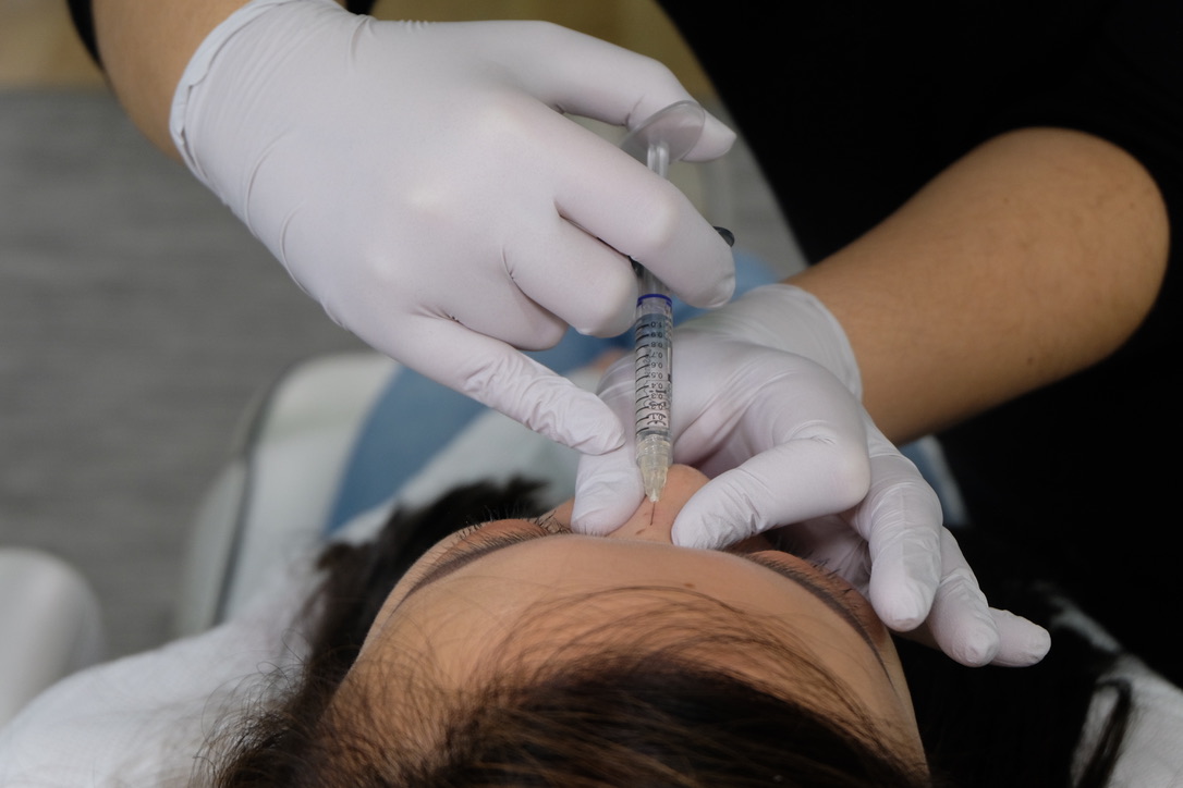 Single Entry Point Nose Job With Cannula - Advanced Training for aesthetic medicine practitioners