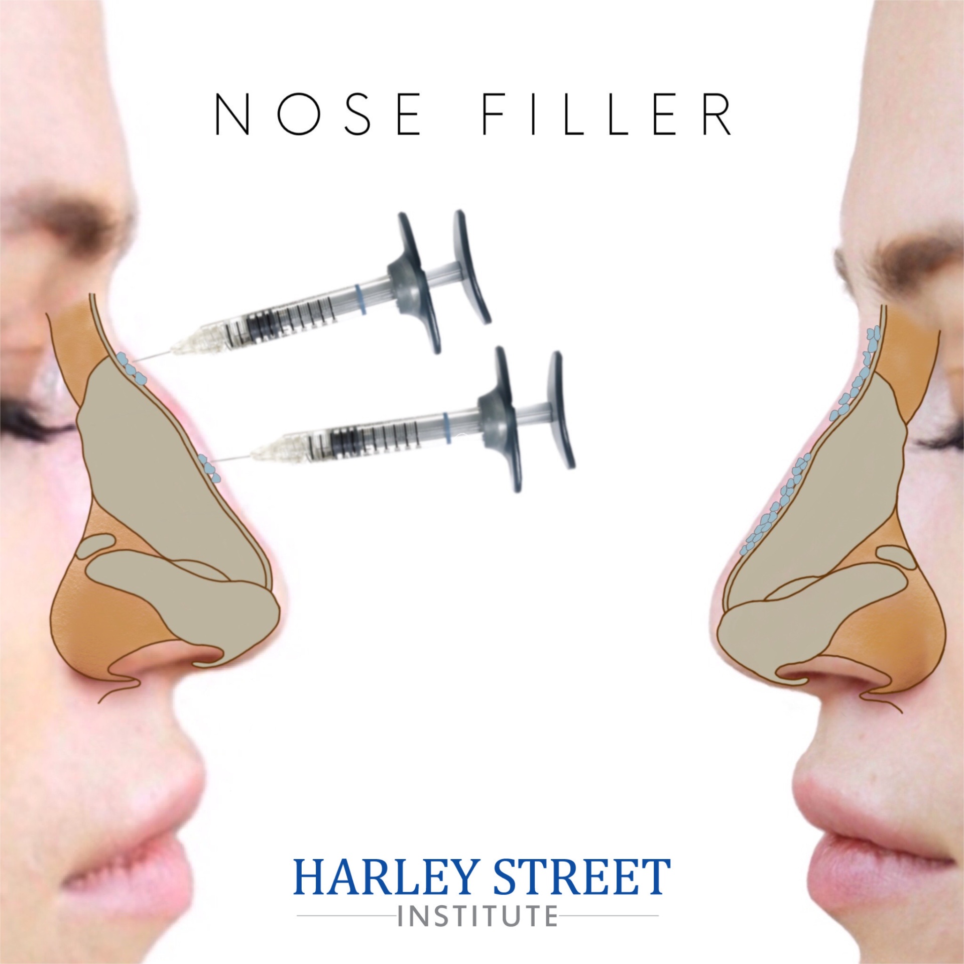 Nose filler injection diagram showing simple soft tissue augmentation