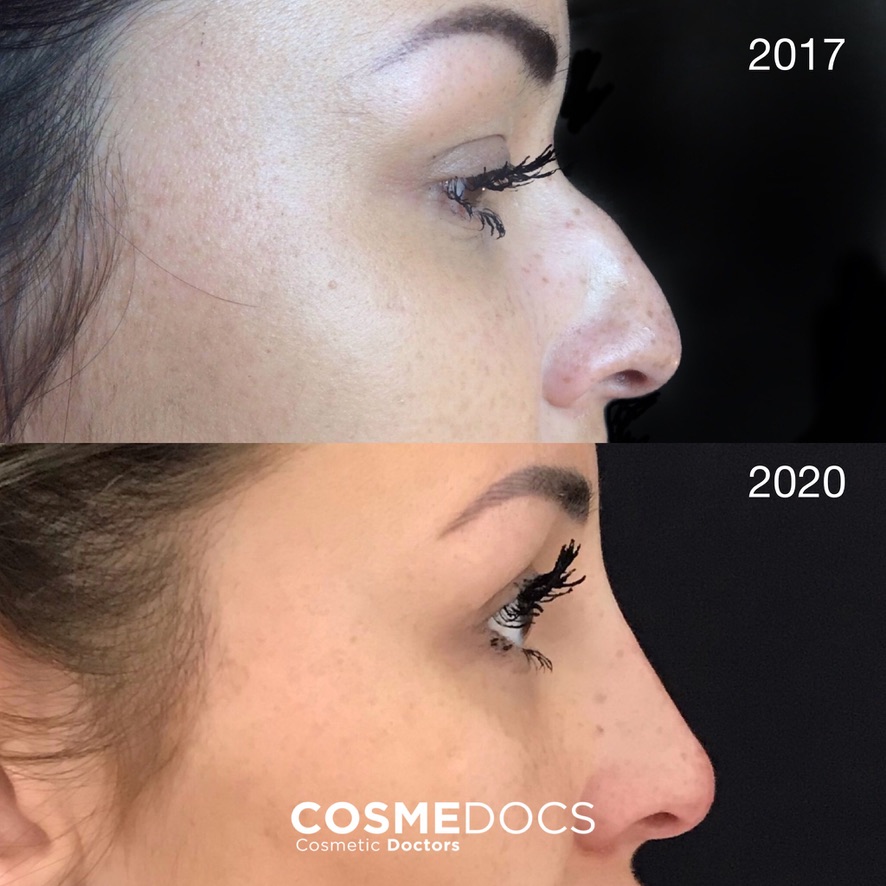 Non-surgical nose reshaping before and after results over 3 years