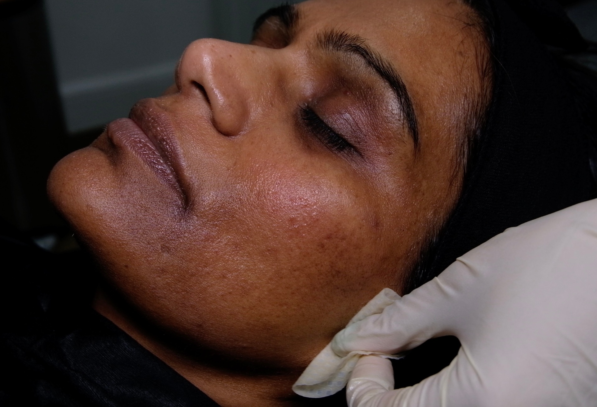 Managing post-inflammatory hyperpigmentation following deep microneedling treatment in deviated skin types