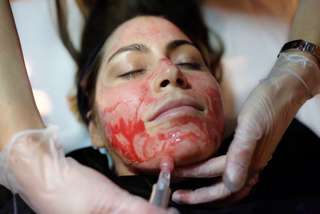 PRP Vampire Facial treatment showing platelet rich plasma application