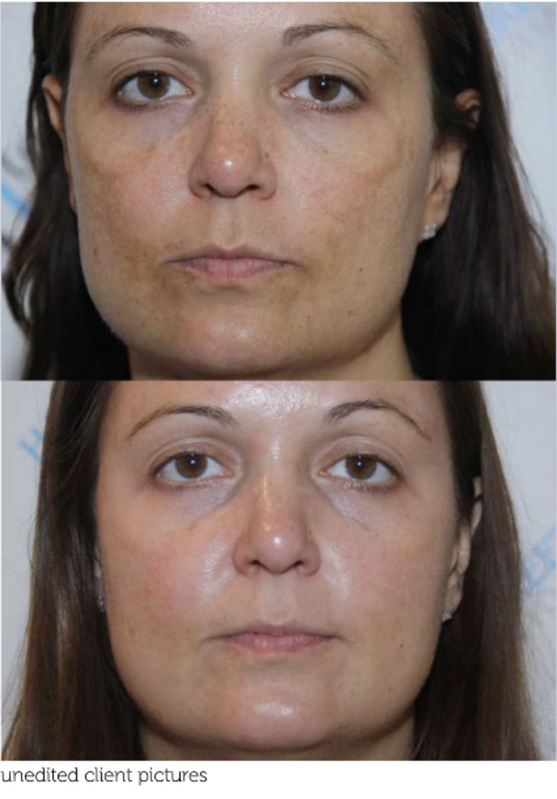 Before and after chemical peel treatment showing improvement in pigmentation and skin tone