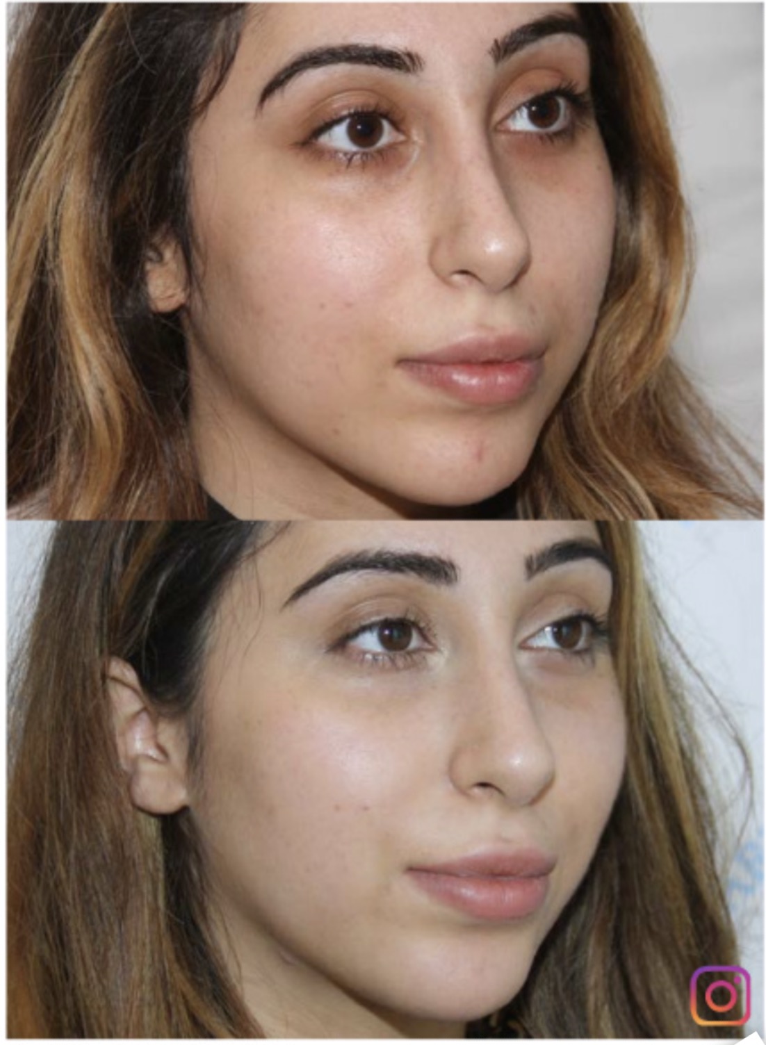 Before and after chemical peel treatment showing clearer, brighter skin