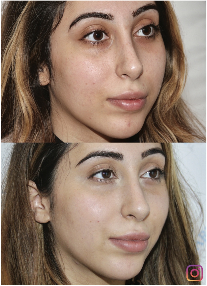 Before and after skin rejuvenation results