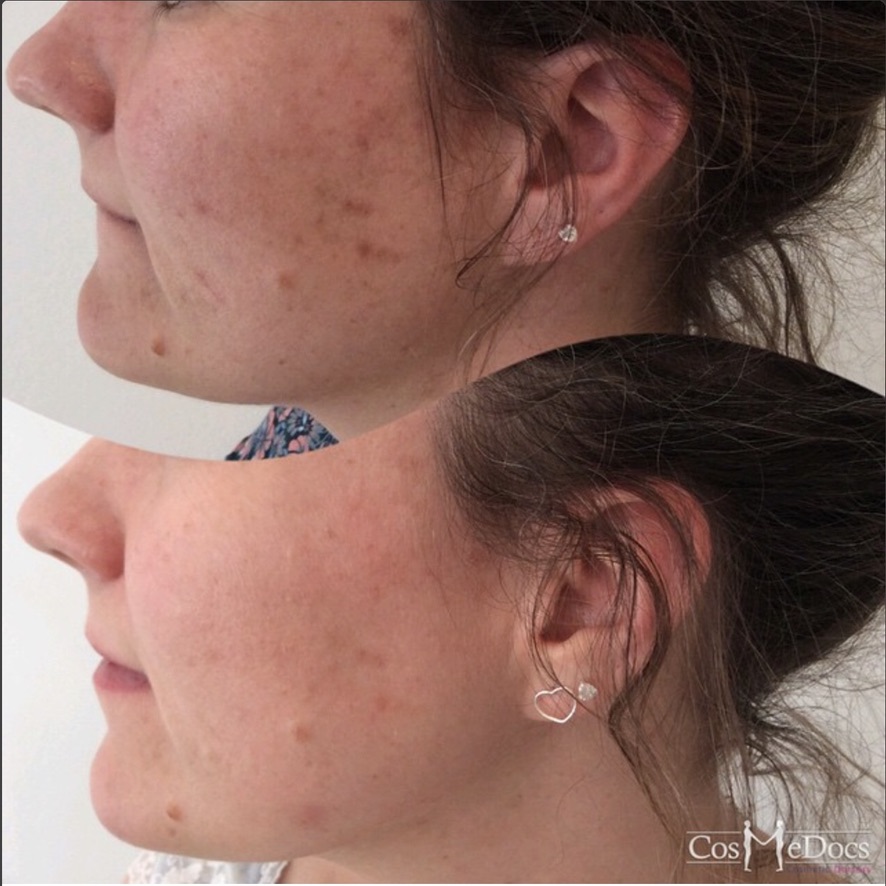 Facial skin texture improvement after treatment