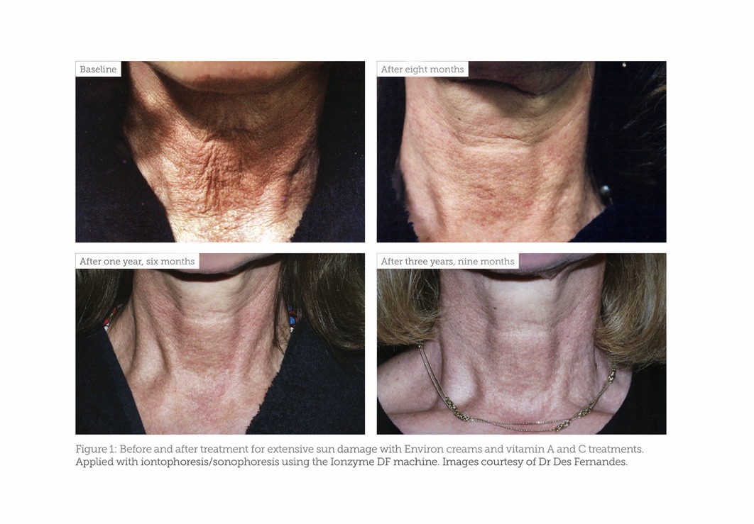 Neck and décolletage skin rejuvenation over time