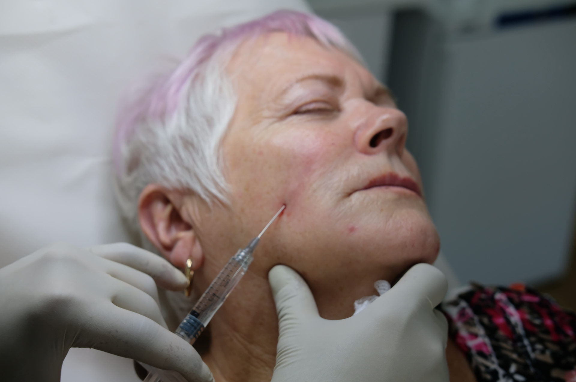 Dr Ahmed Haq aesthetic treatment technique step 3