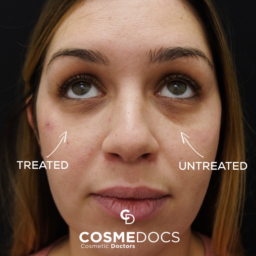 Under-eye treatment results showing treated versus untreated side comparison
