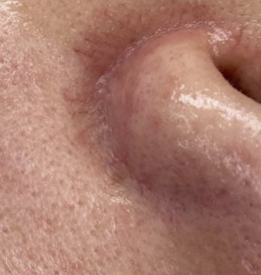 Thread vein treatment result close-up - spider vein removal before and after showing facial vascular treatment