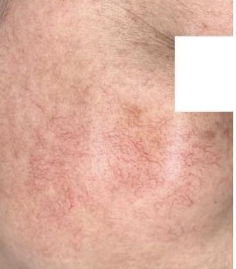 Spider vein treatment on leg - vascular treatment results showing telangiectasia removal