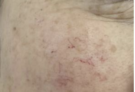 Vascular lesion treatment result - cherry angioma and thread vein removal outcome