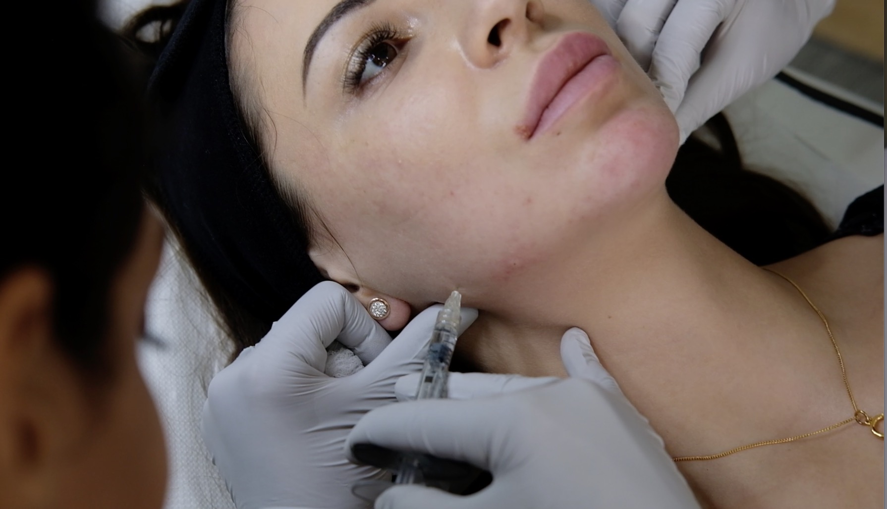 Jawline enhancement procedure