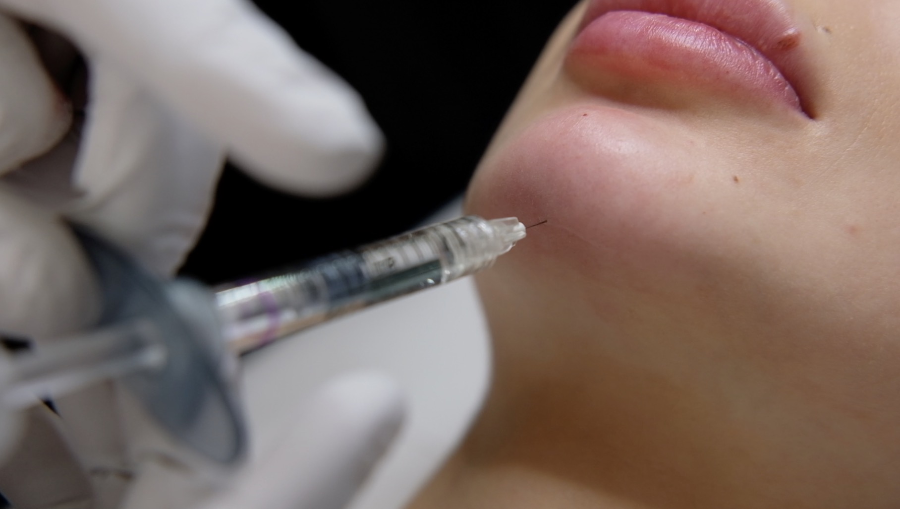 Chin filler injection technique