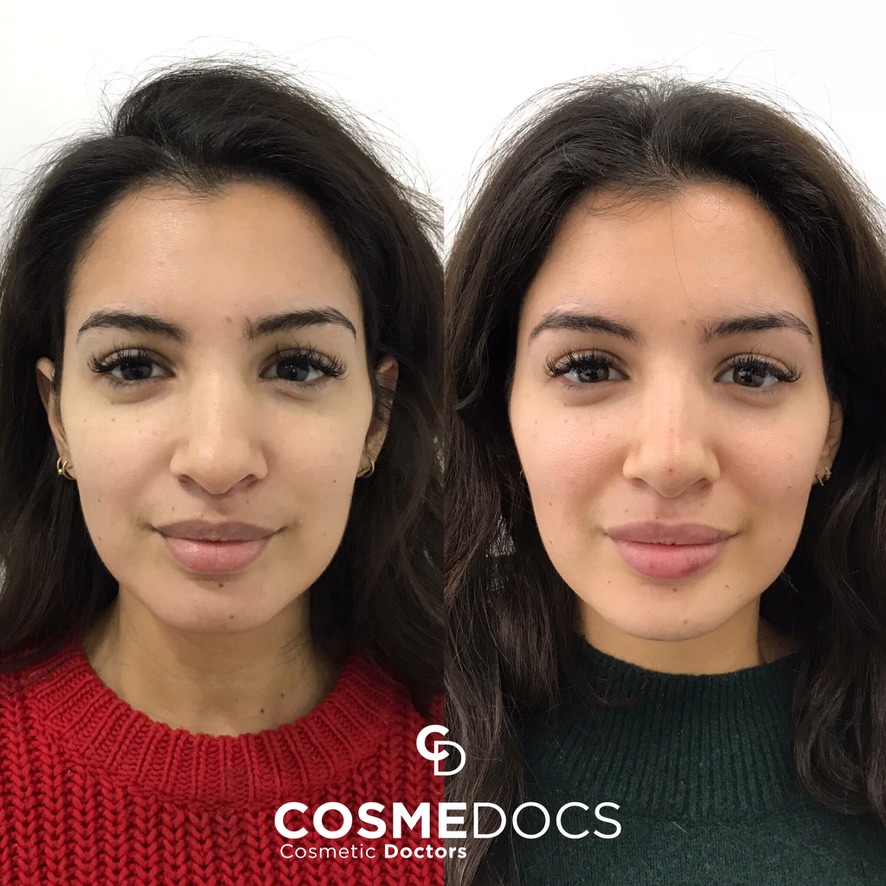 Natural lip enhancement and facial contouring before and after by FACE program graduate