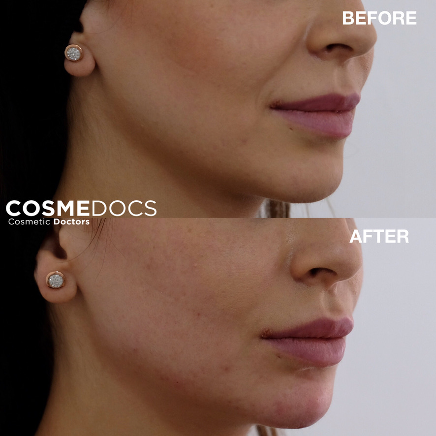 Expert lip filler technique before and after showing natural enhancement by FACE graduate